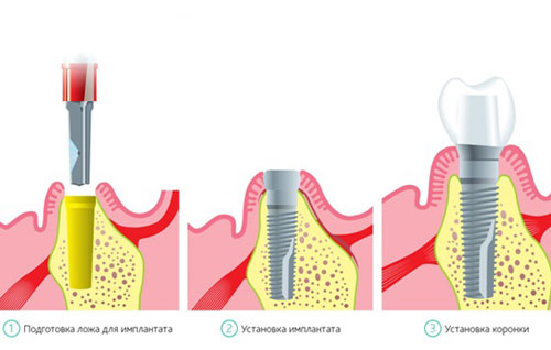 implantaciya vidy i etapy1