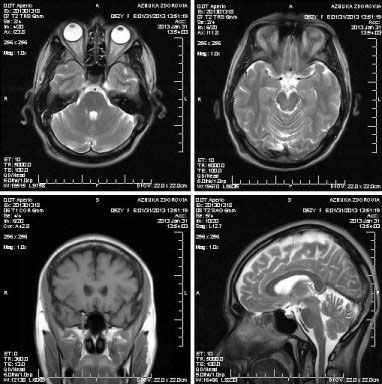 Подготовка к диагностике головного мозга методом МРТ